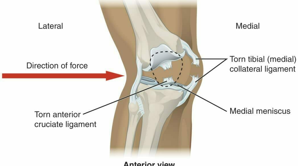 Meniscal Tear | Balance Health Center